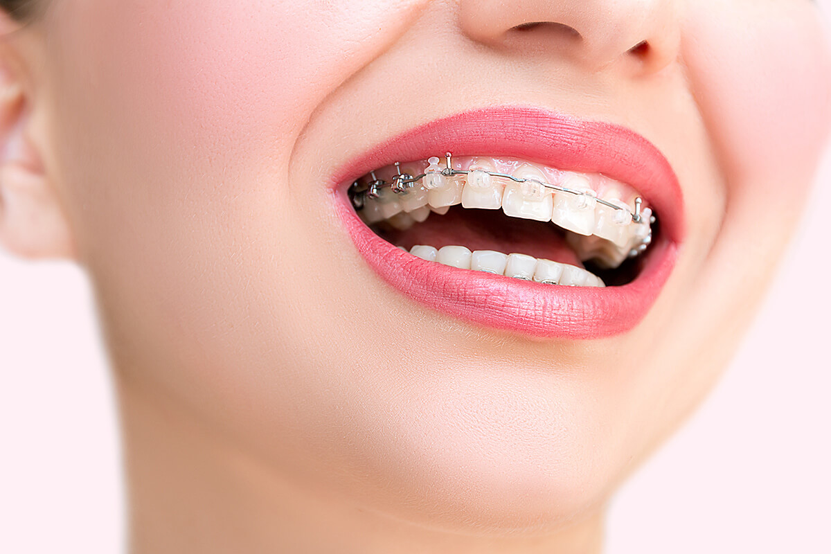Higiena zębów z aparatem ortodontycznym – charakterystyka i znaczenie zabiegów