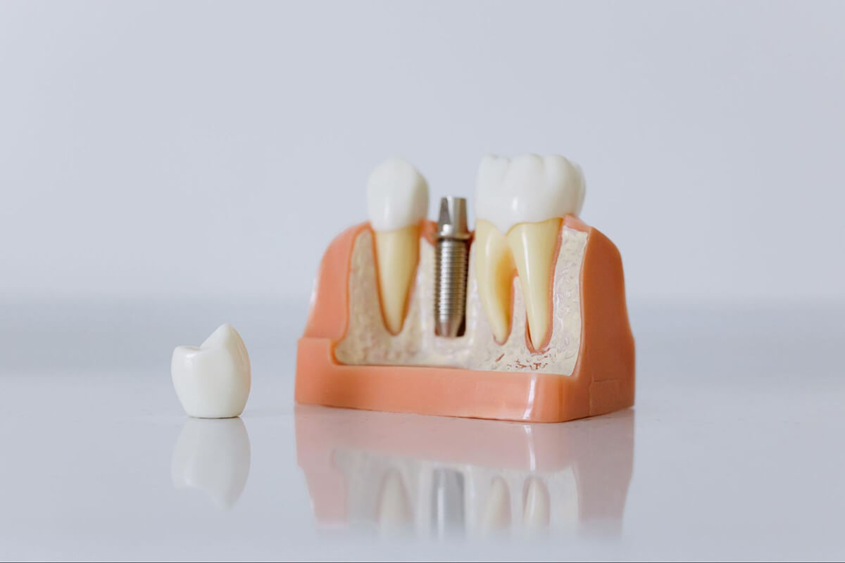 Znaczenie higienizacji zębów w kompleksowym leczeniu implantologicznym