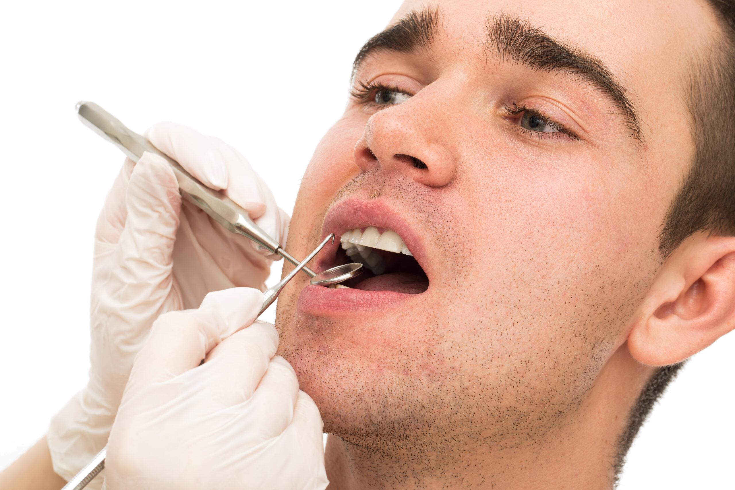 Torbiel korzeniowa zęba — przyczyny, leczenie, zagrożenia